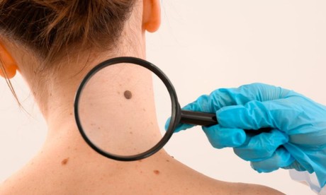 Día del Melanoma: ¿Cómo prevenir el cáncer de piel?