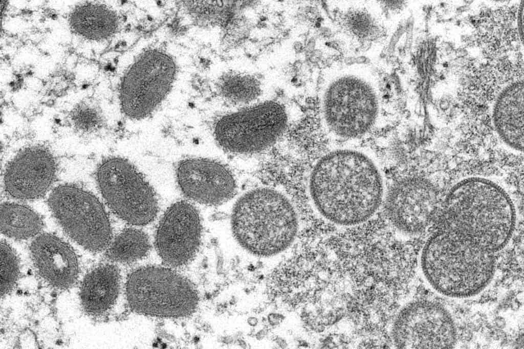 Descarta OMS pandemia por viruela símica