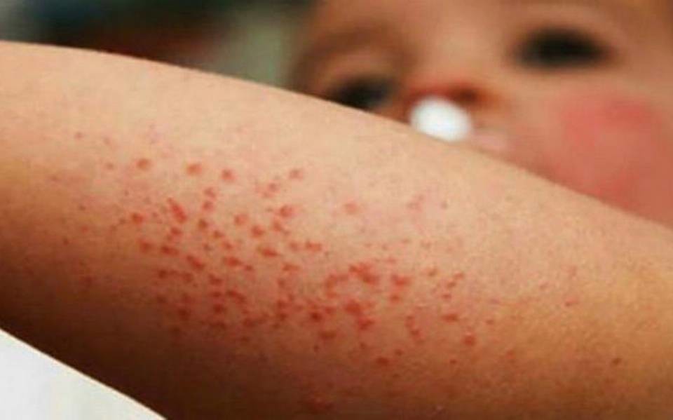 Hombre de Idaho contrae sarampión; autoridades investigan su propagación