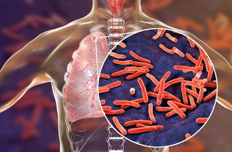 Día Mundial de la Tuberculosis: una enfermedad prevenible y tratable