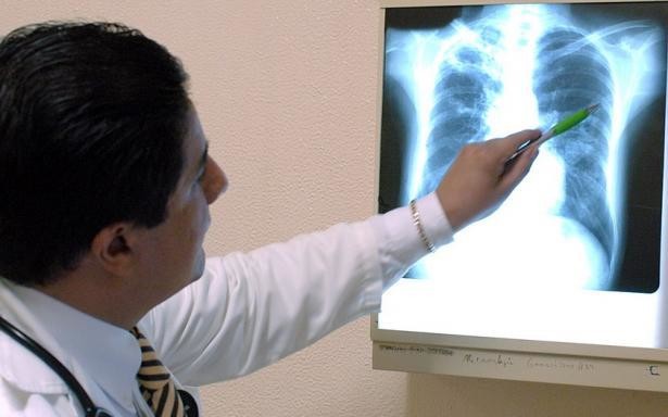 ¿Sospecha de tuberculosis? IMSS Coahuila avisa de casos en el estado
