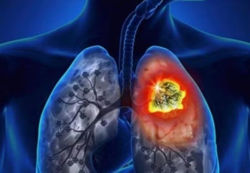 Para prevenir el cáncer de pulmón, se recomienda reducir los factores de riesgo que causan este tipo de cáncer. Foto: Top Doctors.