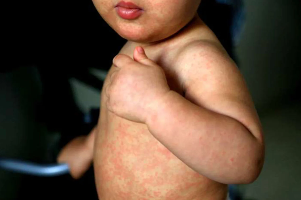 Los niños pequeños son el grupo poblacional más vulnerable ante la enfermedad. Foto: Organización Panamericana de la Salud.