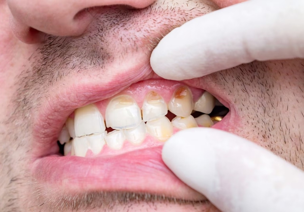 El sarro en los dientes es una placa pegajosa y transparente formada por bacterias. Foto: ClinicMedia.