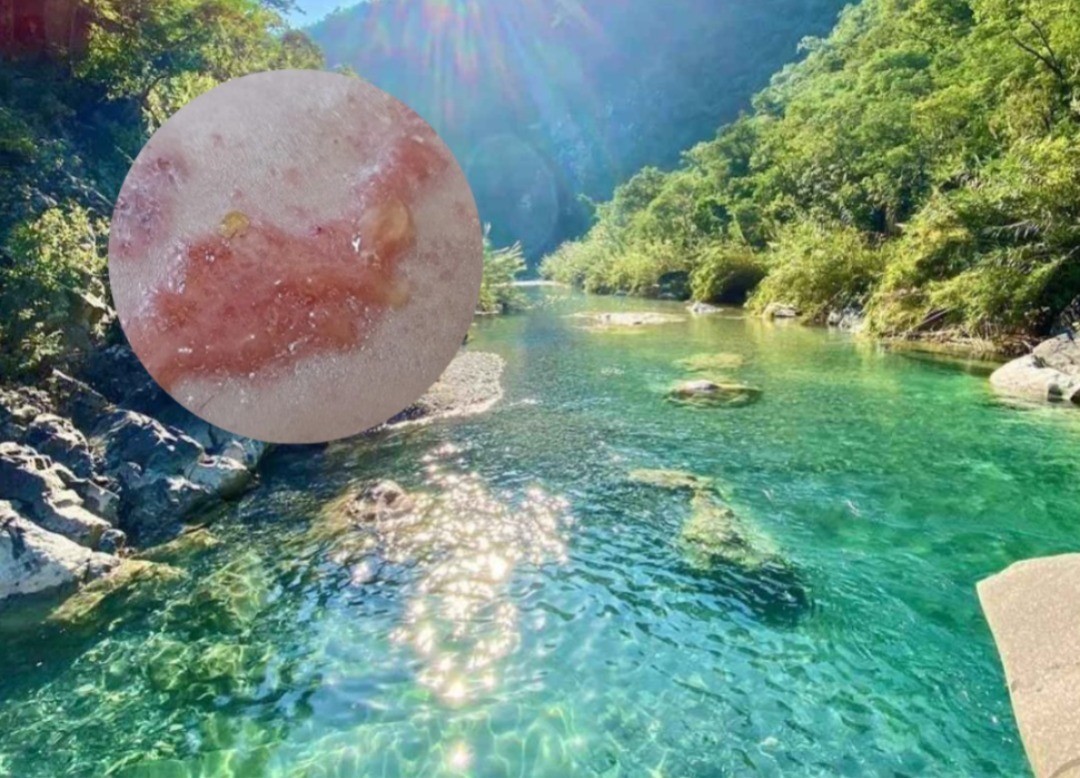 Según la joven la alergía le dio tras estar en contacto con la hiedra venenosa. Foto: Canva.