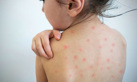 Alerta de la OMS: 35 millones de niños sin vacuna contra el sarampión