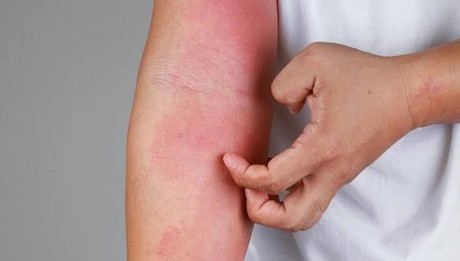 OMS: Al menos 30% de la población mundial padece algún tipo de alergia.