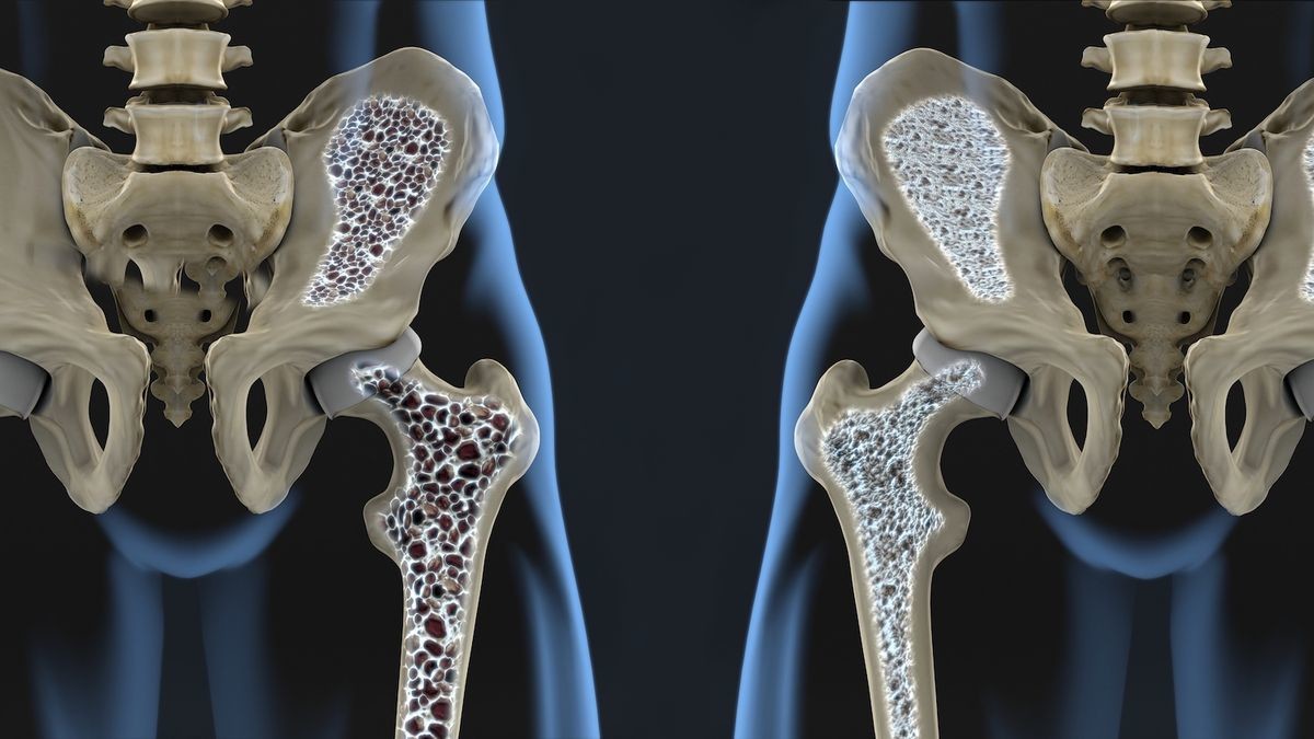 Estudio de Osteoporosis. (Image credit: Shutterstock)