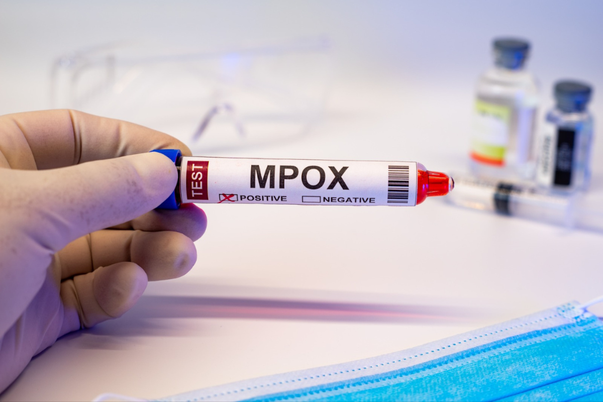 Primer caso de MPOX en BCS 2024. Foto: Adobe Stock