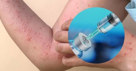 Vacuna contra Mpox espera aprobación de Cofepris en caso de emergencia: Ssa