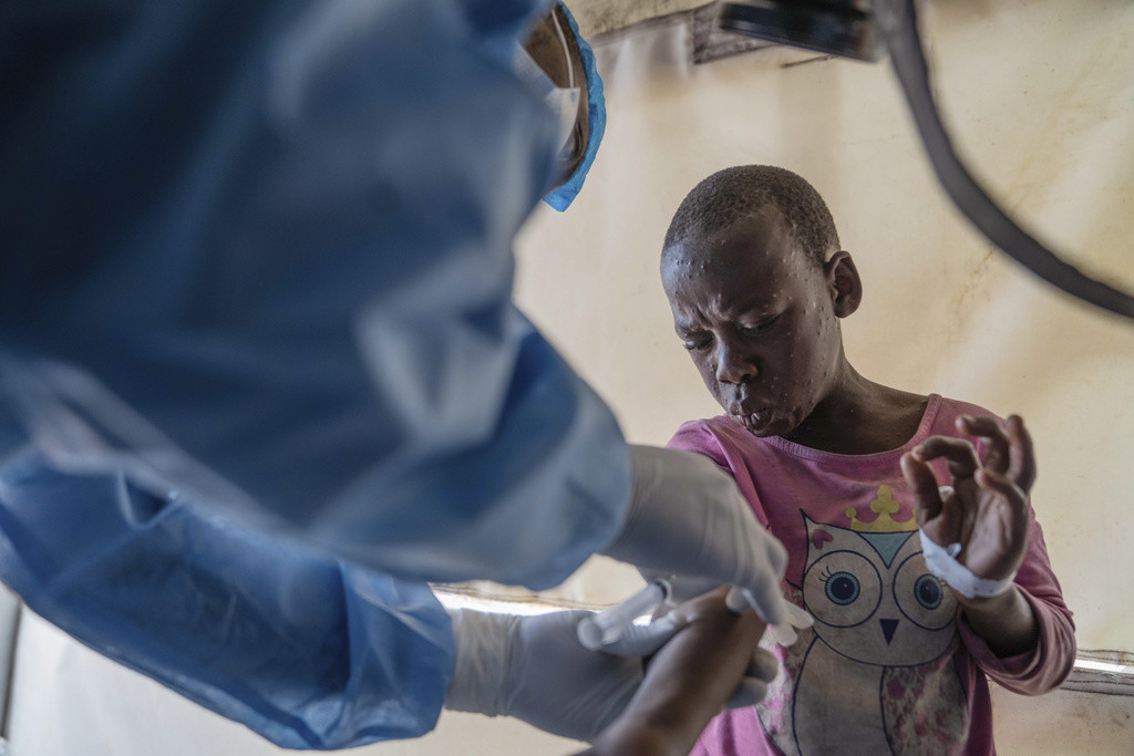 Personal de salud atiende a un paciente con viruela símica en un centro de tratamiento en Munigi, en la República Democrática del Congo, el 19 de agosto de 2024. (AP Foto/Moses Sawasawa, archivo)