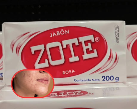 ¿El jabón de Zote es una alternativa para el acné? Esto debes saber