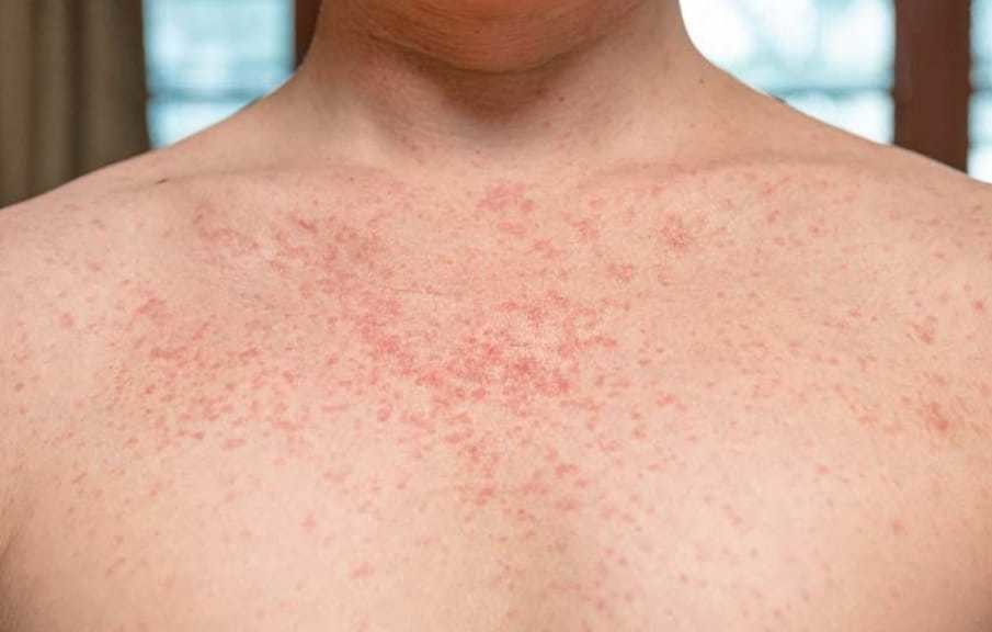 La OMS alertó por un aumento en los casos de sarampión a nivel mundial. (FOTO: Shutterstock)