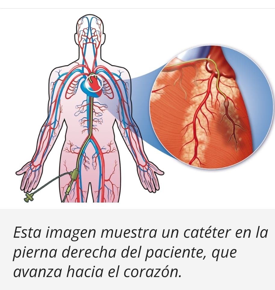 Ricardo Casares tuvo que ser intervenido quirúrgicamente mediante un cateterismo cardiaco. IMAGEN: National Institutes of Health (NIH)